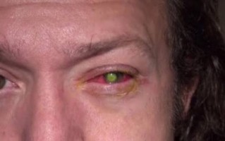 戴隐形眼镜睡觉了怎么办，戴隐形眼镜睡觉的话会怎样
